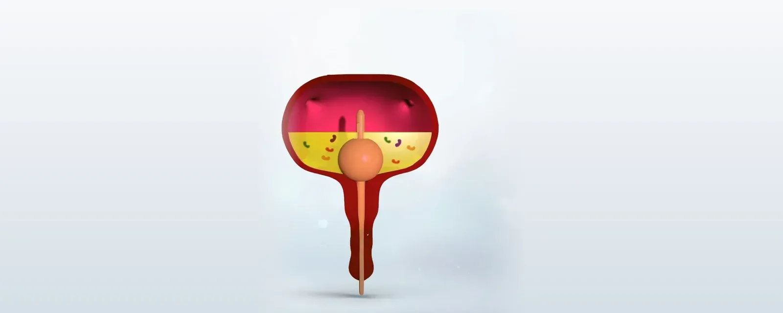 Coated Foley catheter: balloon holds the drainage eye above pooled urine
