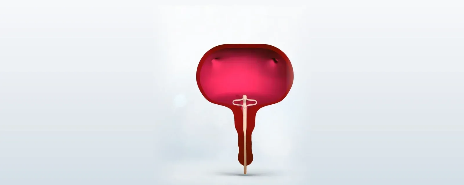Lotus Catheter: wings sit low with near-complete drainage
