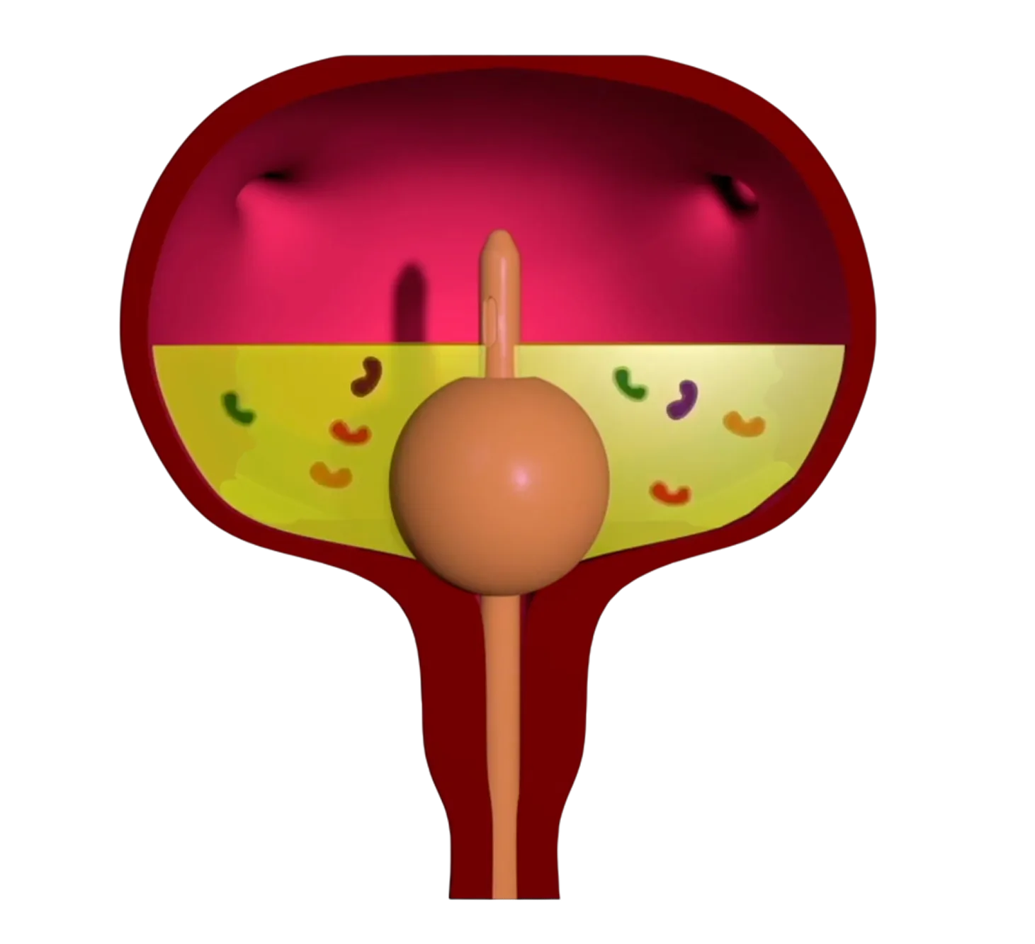 Foley catheter with an inflated balloon